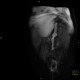 Dystrophic ossification in scar, linea alba, median laparotomy: CT - Computed tomography